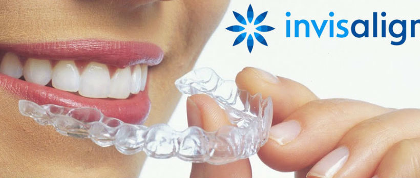 Invisalign: mitos e verdades e onde fazer o tratamento no Rio de Janeiro