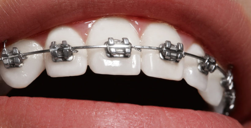 Aparelho dental: todo mundo precisa usar?